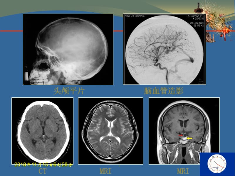 CT MRI颅脑影像看片PPT演示课件_第3页
