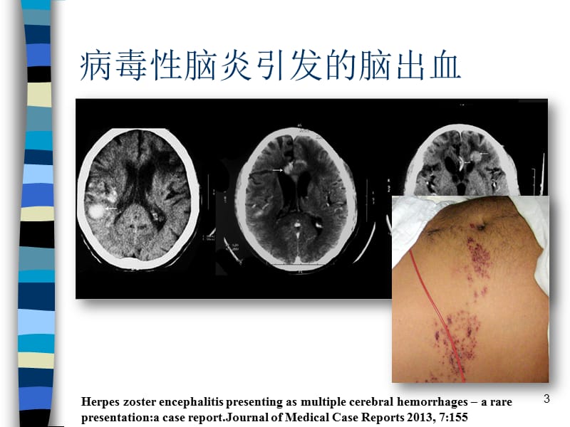 子宫内膜癌NCCN指南解读PPT演示课件_第3页