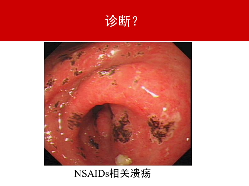 NASIDs相关胃肠道损伤的PPI应用医学幻灯片_第3页