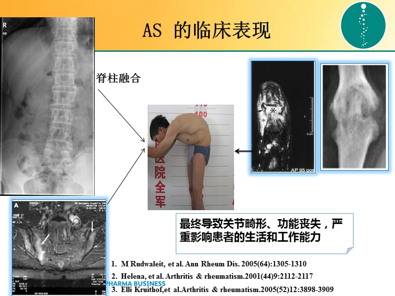 NEW-AS早期诊断ppt课件_第3页