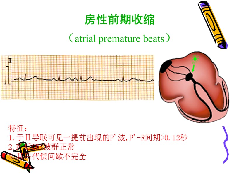 常见心律失常的ECG表现及药物治疗医学PPT_第3页