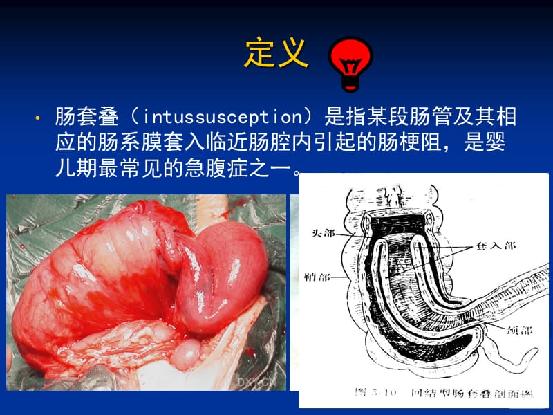 肠套叠空气灌肠复位技巧及注意事项医学PPT_第3页