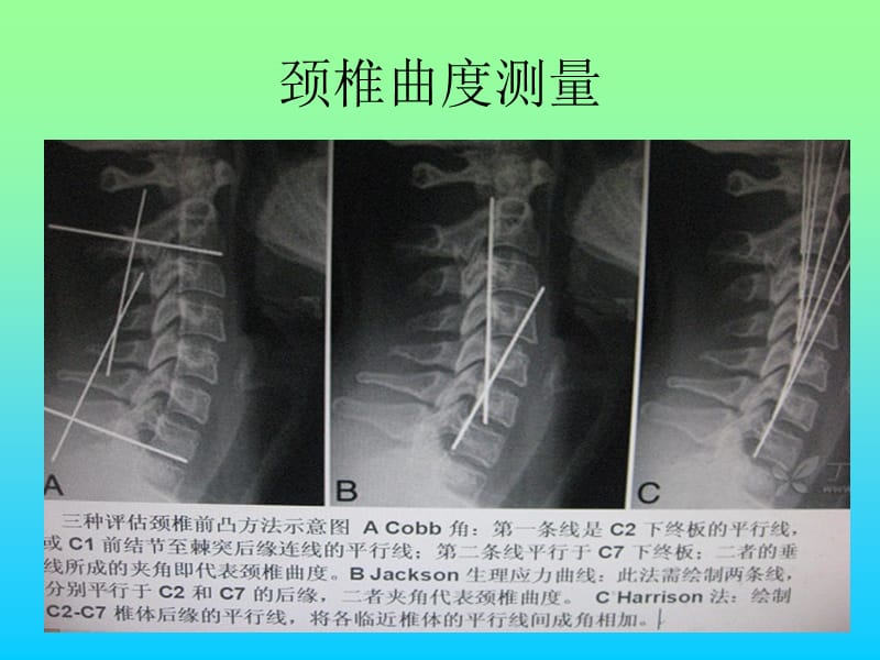 常用脊柱测量方法及其临床意义医学PPT_第2页