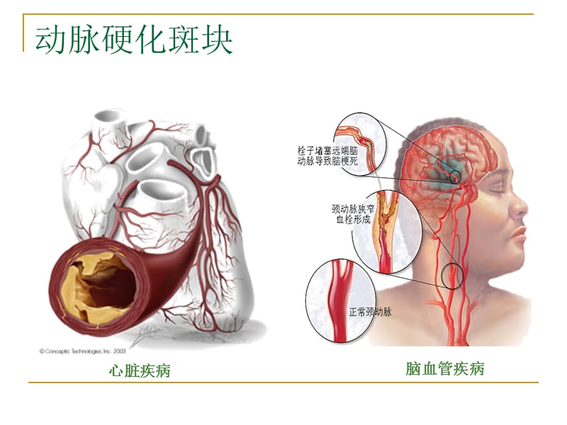 大动脉粥样硬化性脑梗塞医学PPT_第2页