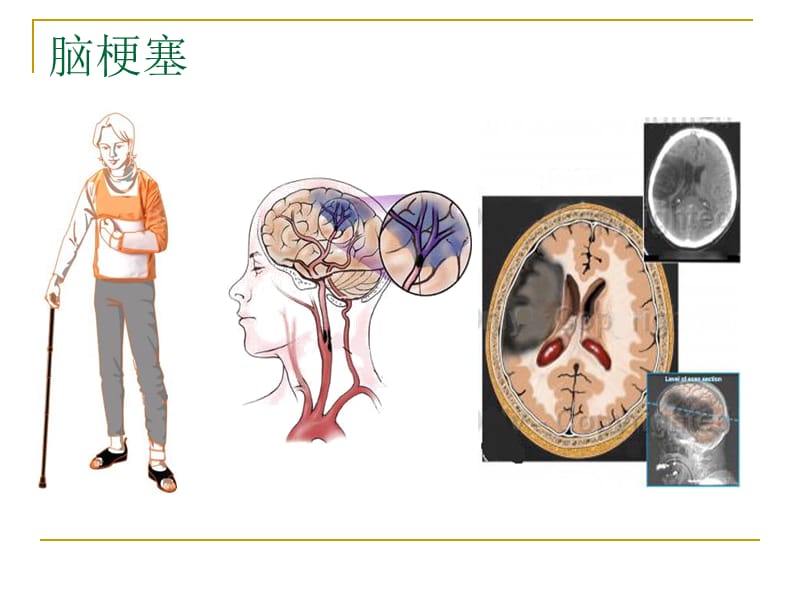 大动脉粥样硬化性脑梗塞医学PPT_第3页