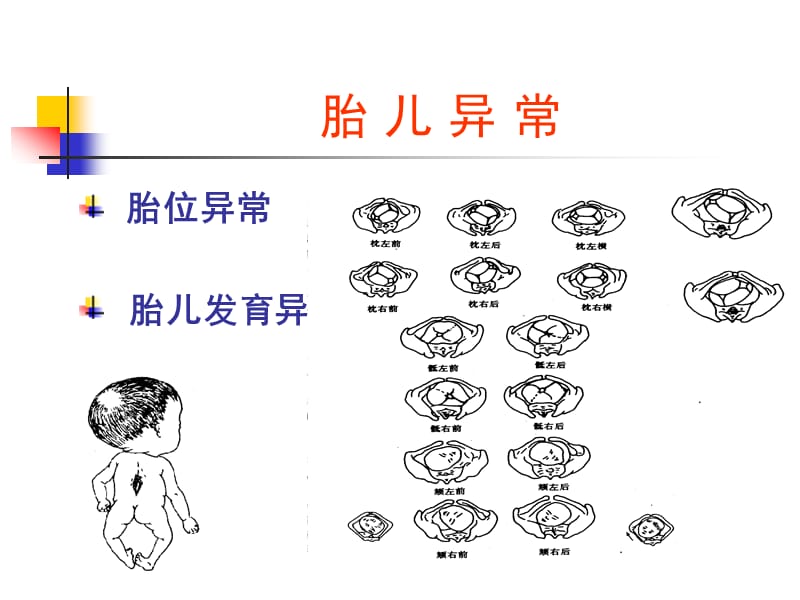 异常分娩、胎位异常_第3页