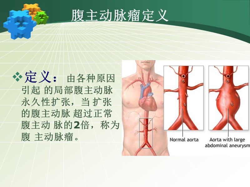 腹主动脉瘤PPT课件_第3页