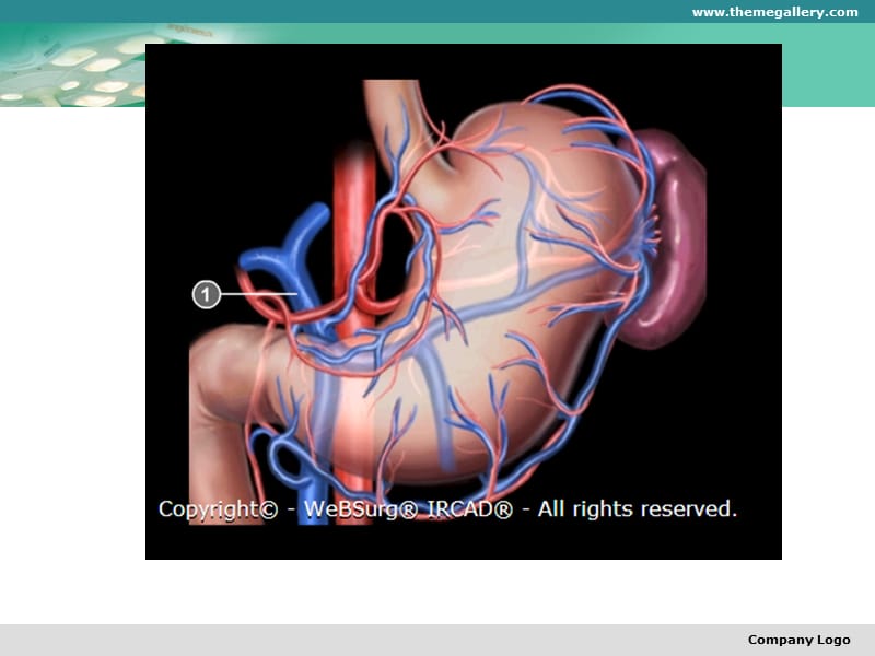 腹腔镜下胃周血管的解剖PPT课件_第3页