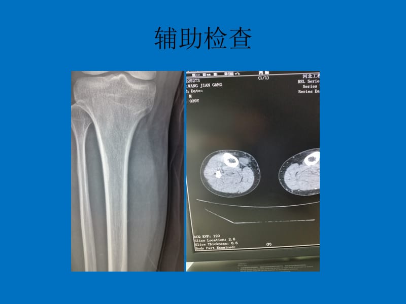 恶性纤维组织细胞瘤医学PPT_第3页