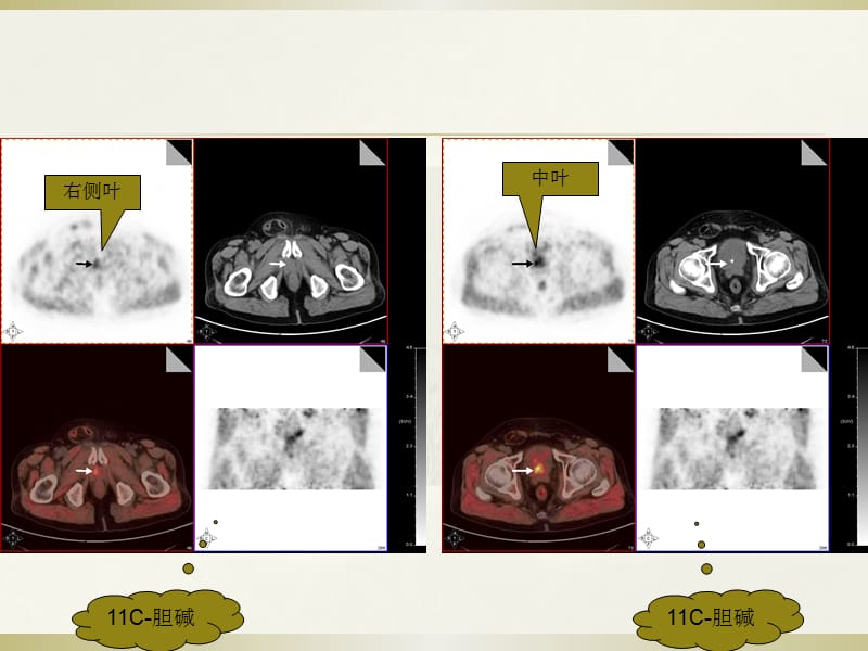 胆碱 PET CT 前列腺癌PPT课件_第3页