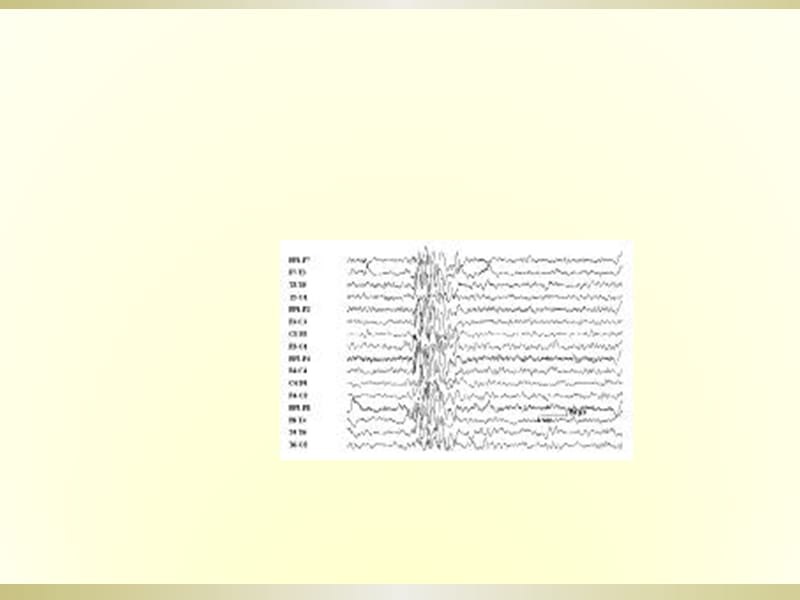 癫痫的治疗PPT课件_第2页
