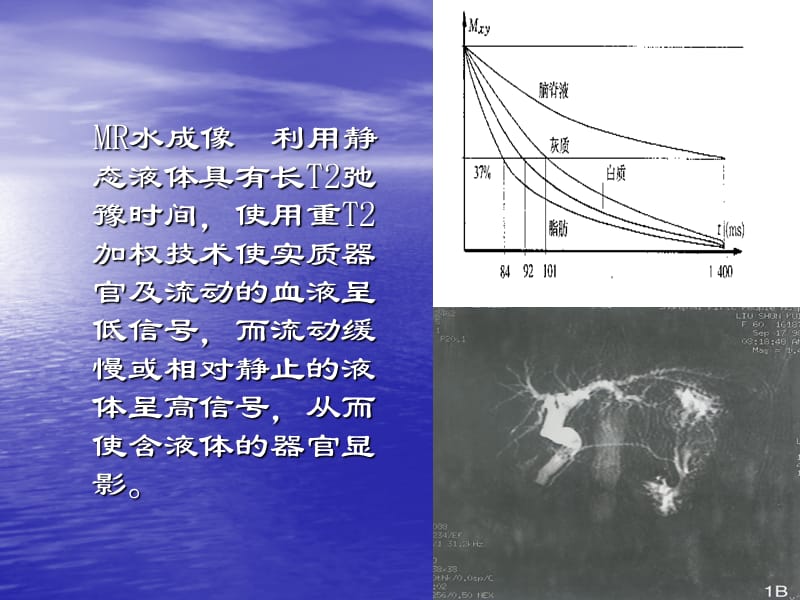 MR水成像ppt课件_第2页