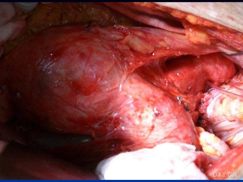 腹主动脉瘤人工血管置换术的麻醉PPT课件_第3页