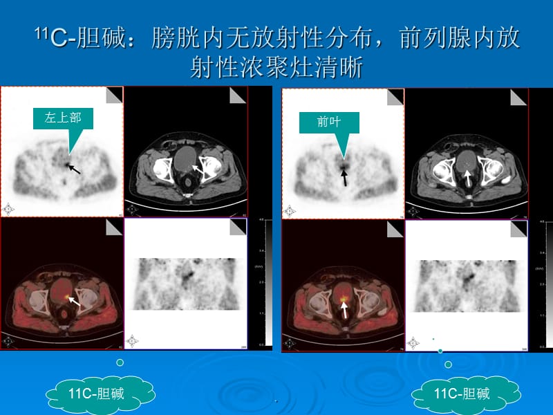 胆碱 PET CT 前列腺癌PPT演示课件_第2页