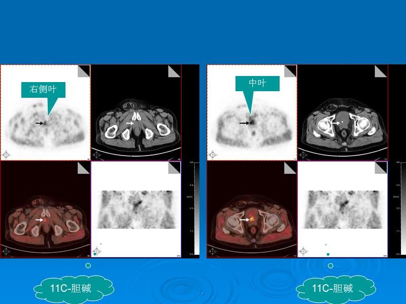 胆碱 PET CT 前列腺癌PPT演示课件_第3页