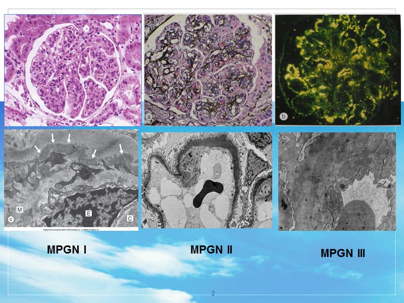 C3肾小球病新概念及专家共识PPT课件_第2页