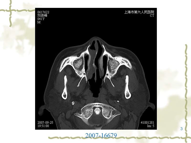 成骨性肿瘤PPT课件_第3页