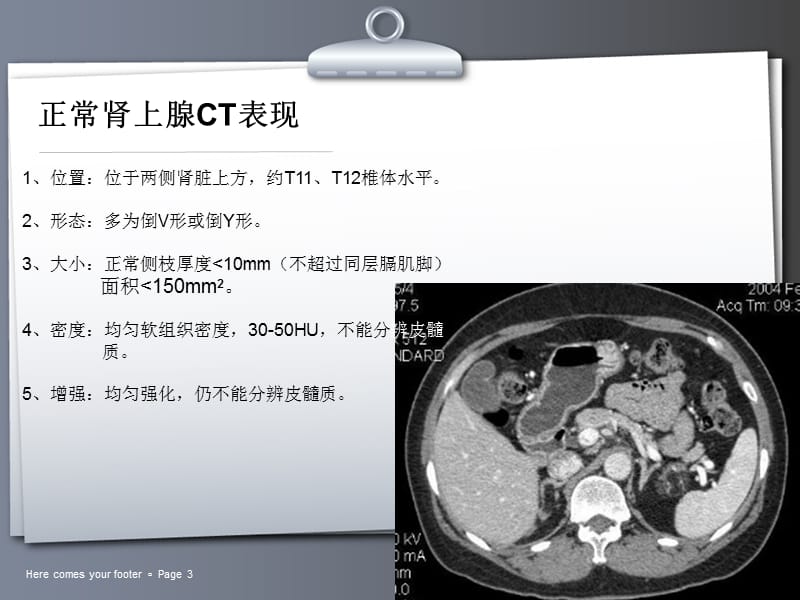 常见肾上腺肿瘤的CT诊断与鉴别诊断ppt课件_第3页