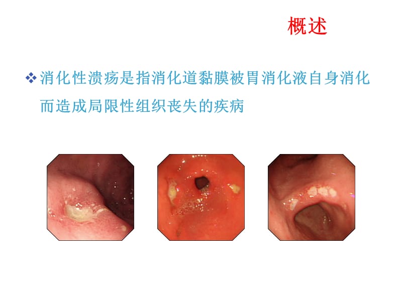 儿童消化性溃疡的诊治PPT课件_第3页