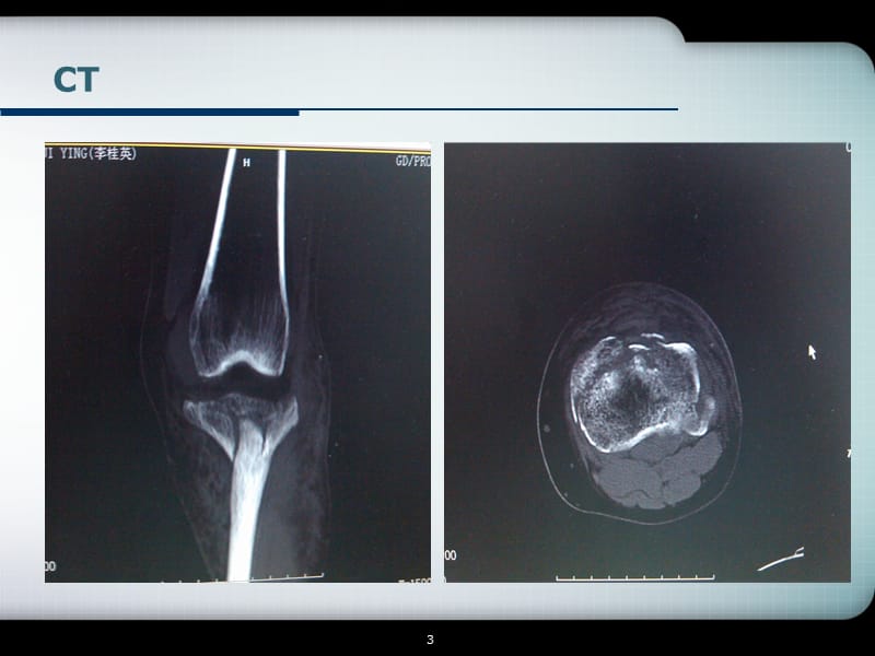 胫骨平台骨折的诊断与分型PPT课件_第3页