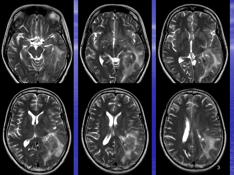 横纹肌样脑膜瘤读片ppt课件_第3页
