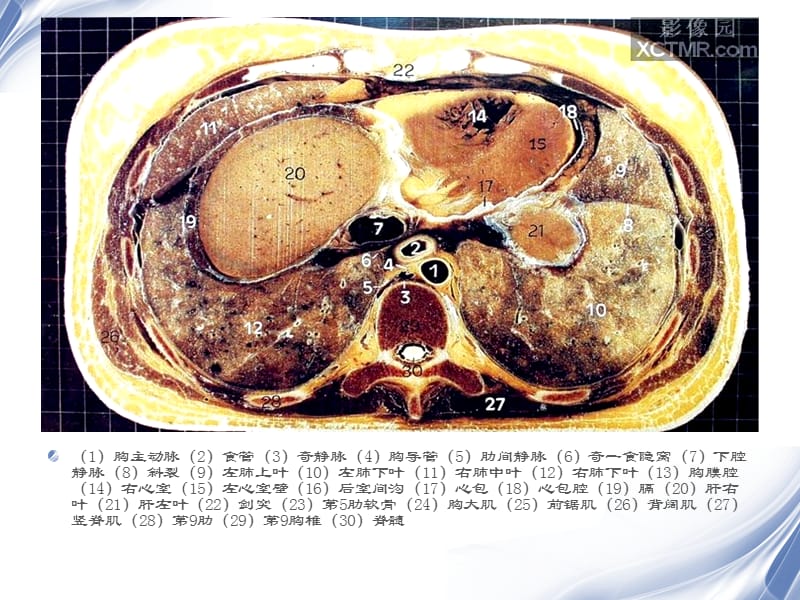 人体断层解剖图谱腹腔PPT演示课件_第3页