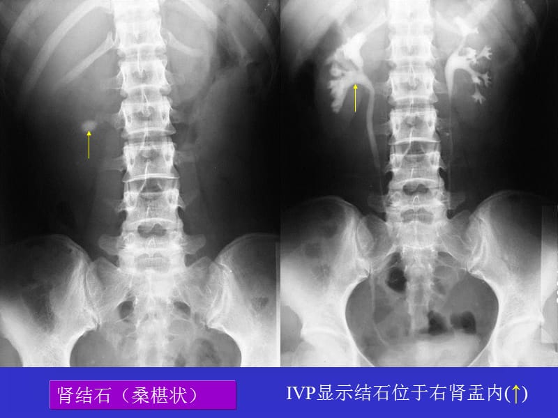 泌尿系统之结石PPT演示课件_第3页