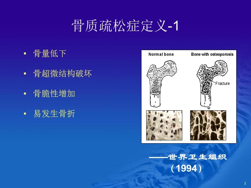 骨质疏松症的诊断与治ppt课件_第3页