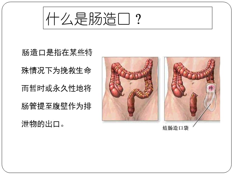 肠造口术PPT演示课件_第3页