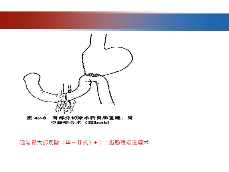 肠道手术后肠瘘的发生与对策PPT演示课件_第3页