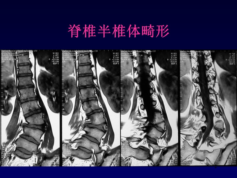 脊柱及脊髓病变的MRI表现PPT课件_第2页