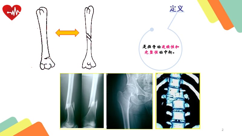 骨折病的护理PPT课件_第2页