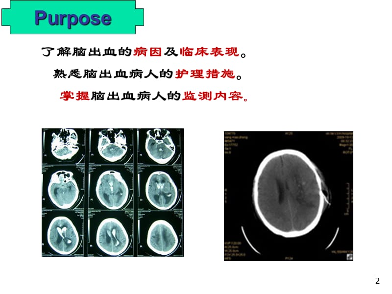 脑出血的护理PPT课件_第2页