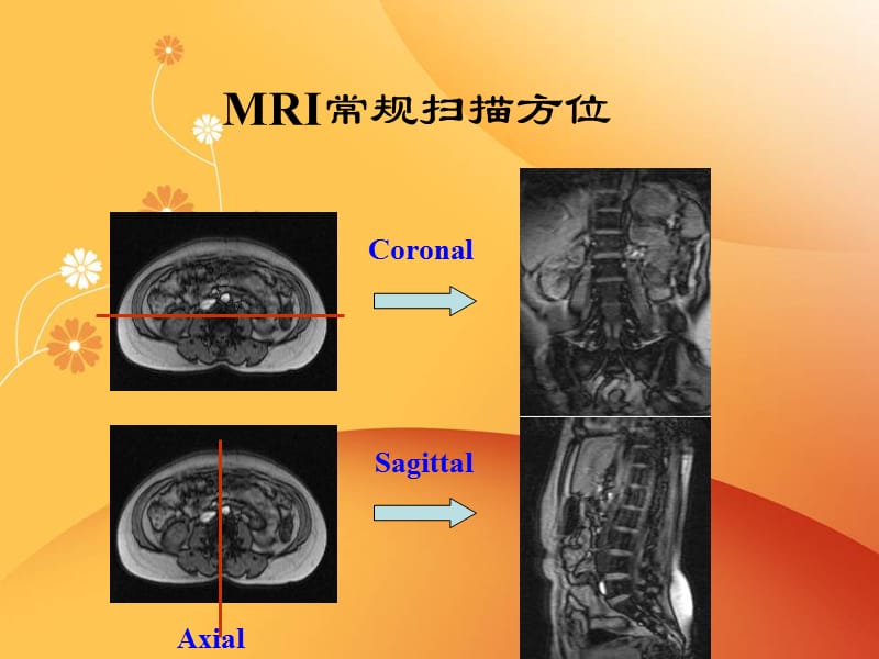 脊柱常见疾病的MRI诊断PPT课件_第3页