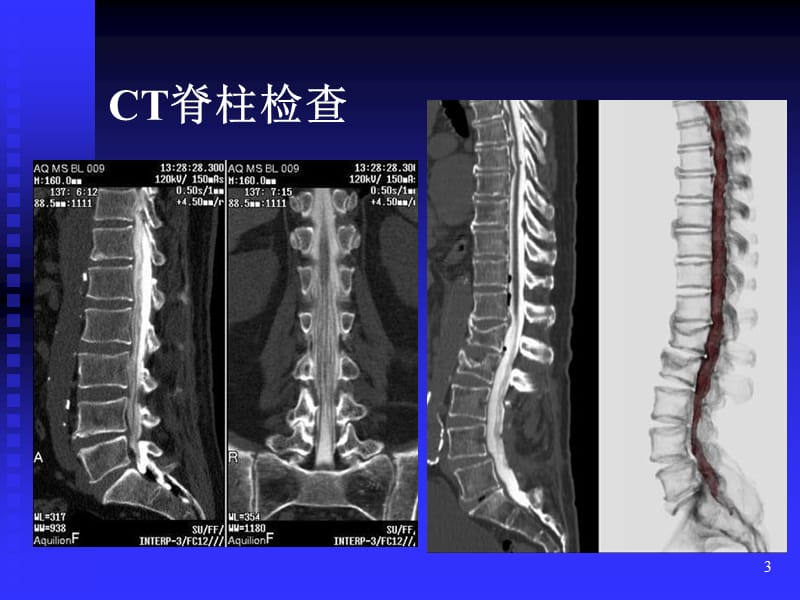 脊柱肿瘤 ppt课件_第3页