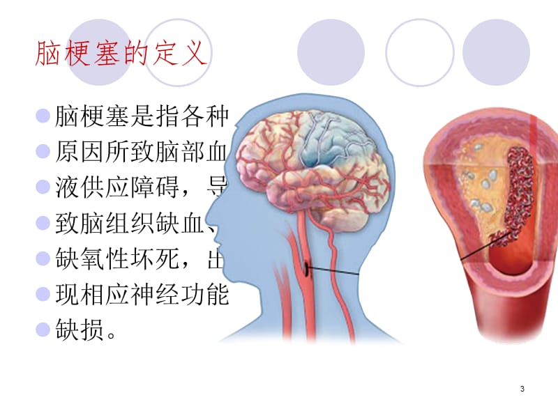 脑梗塞护理病例讨论PPT课件_第3页