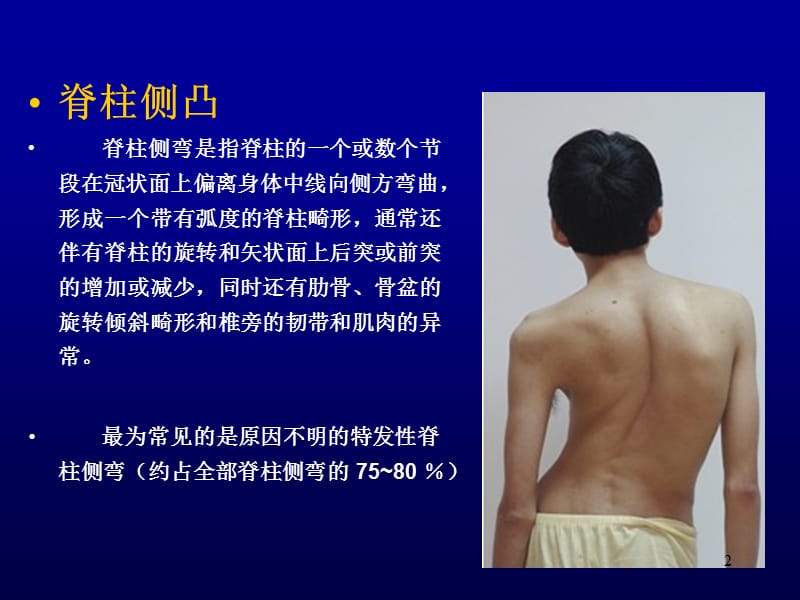 青少年特发性脊柱侧弯畸形的三维矫形治疗PPT课件_第2页
