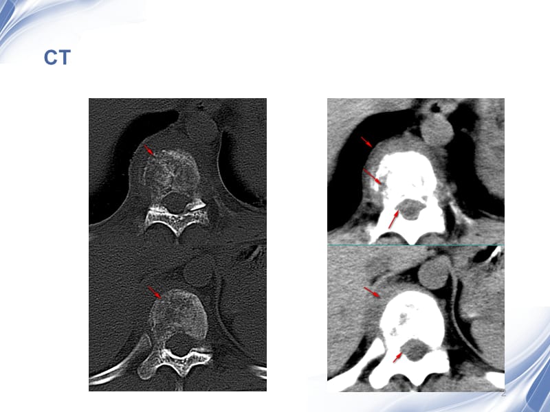 脊柱原发性恶性淋巴瘤的影像诊断ppt课件_第2页