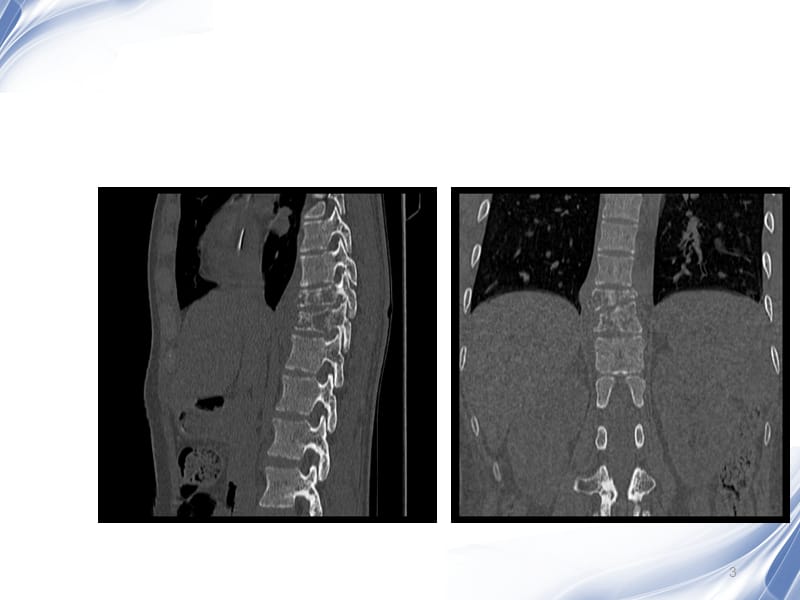 脊柱原发性恶性淋巴瘤的影像诊断ppt课件_第3页