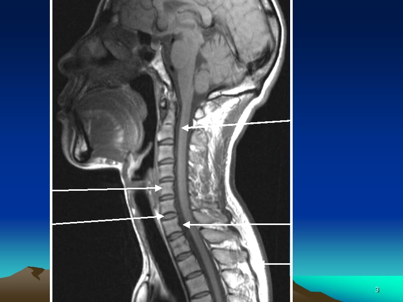 脊髓和椎管内疾病PPT课件_第3页