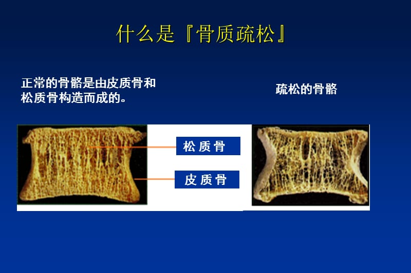 老年骨质疏松症PPT演示课件_第2页