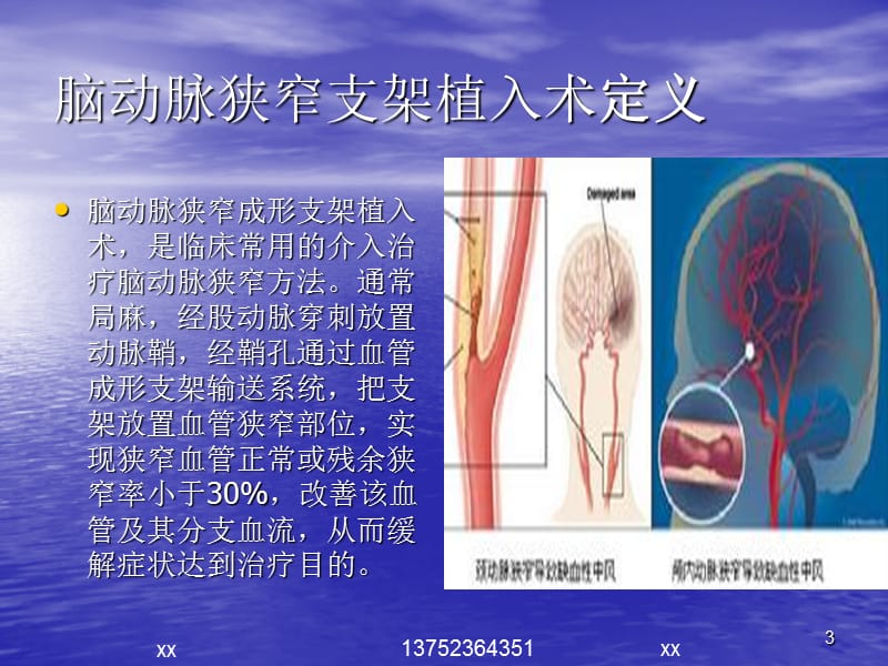 脑动脉狭窄支架植入术及护理PPT课件_第3页