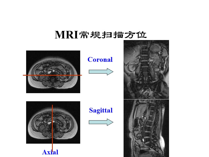 脊柱常见疾病需要MRI诊断ppt课件_第2页