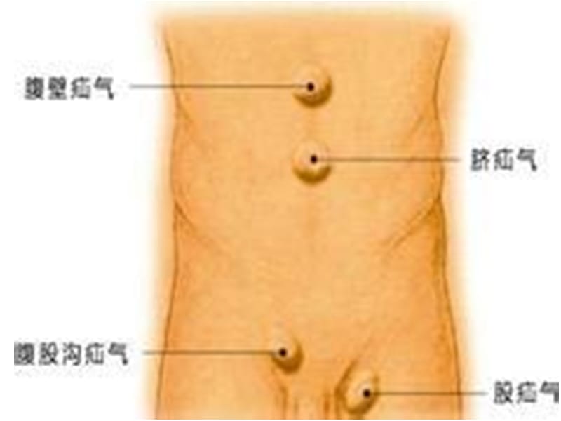 腹外疝病人的护理分析PPT演示课件_第3页