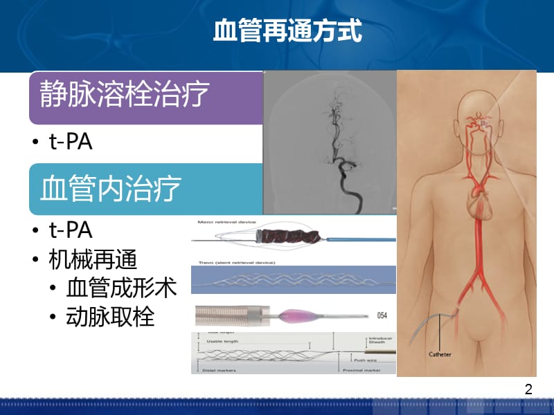 急性卒中血管再通治疗后管理 ppt课件_第2页