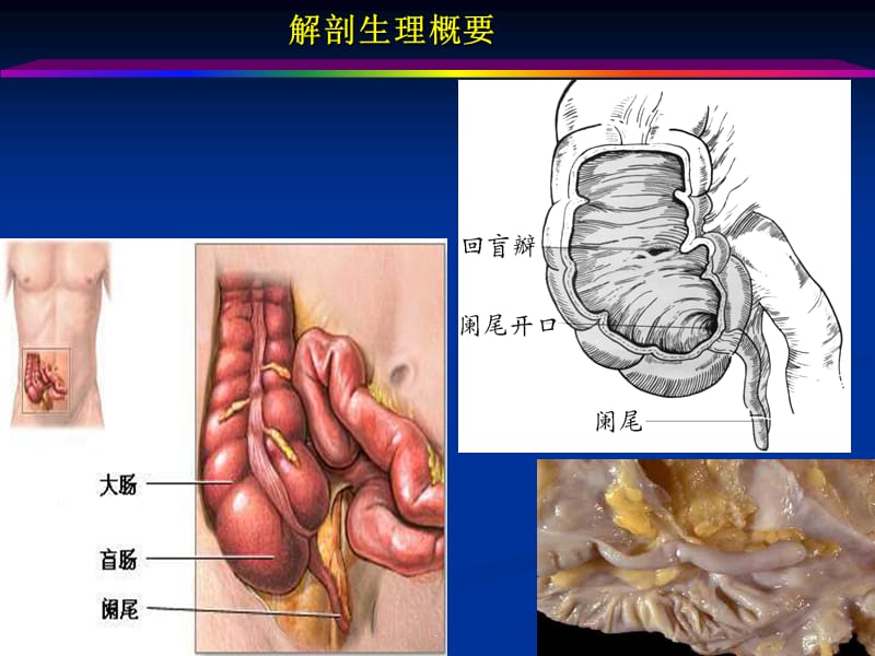 阑尾炎PPT演示课件_第2页