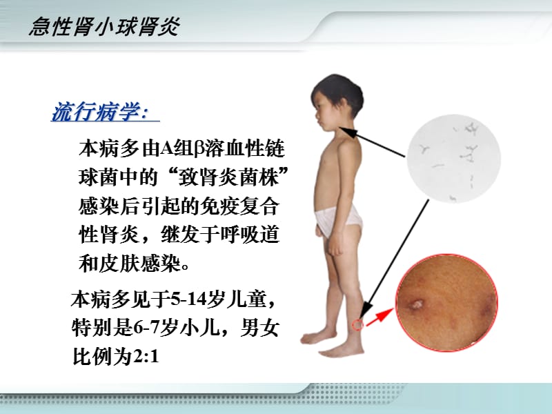 急性肾小球肾炎 ppt课件_第3页