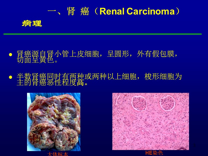 男生殖系统肿瘤PPT课件_第3页