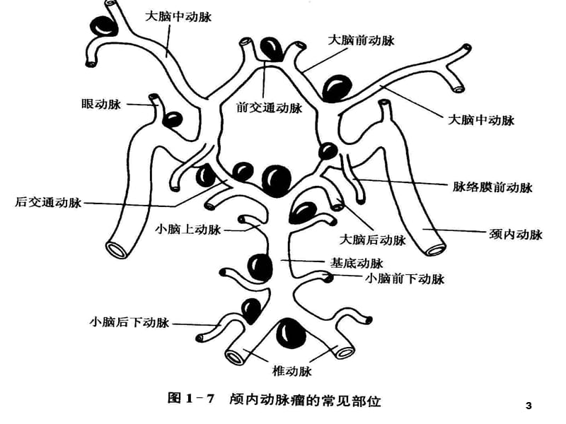 动脉瘤ppt课件_第3页