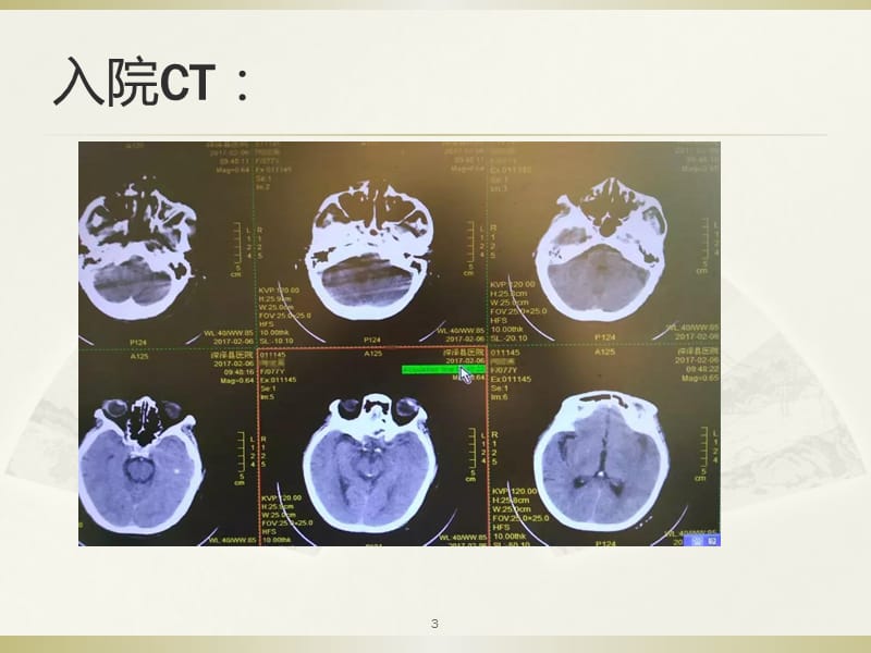 大面积脑梗塞手术还是保守治疗 PPT课件_第3页